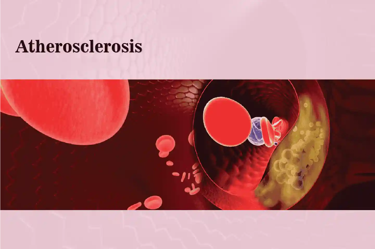 Atherosclerosis